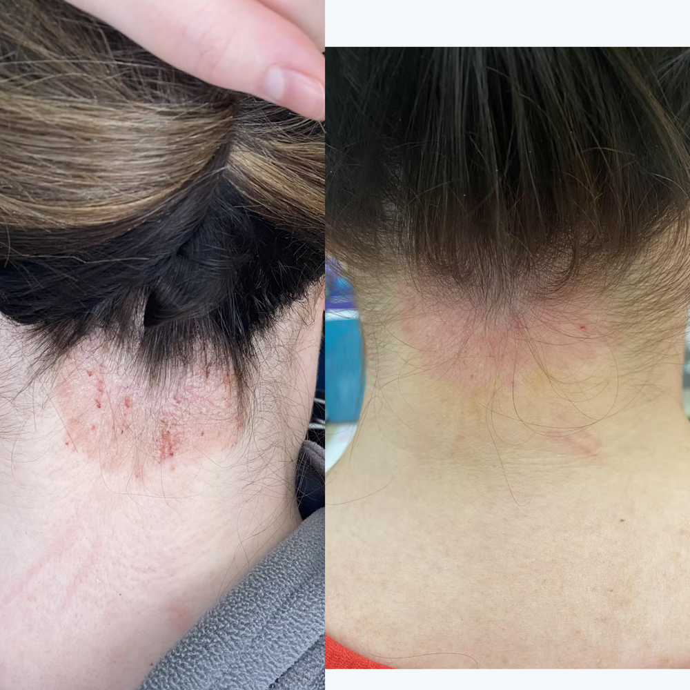 Back of the neck before and after using Marin