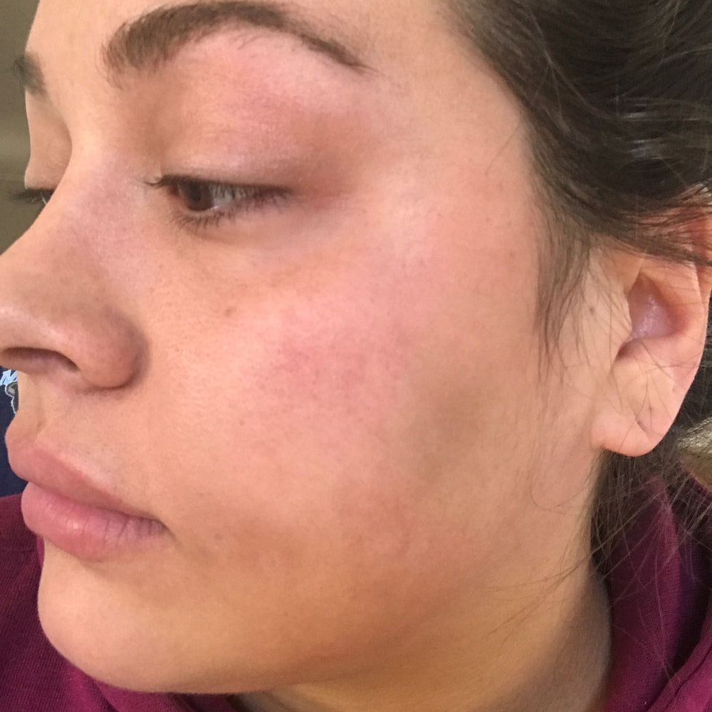 Clearer skin on the cheek after using Marin