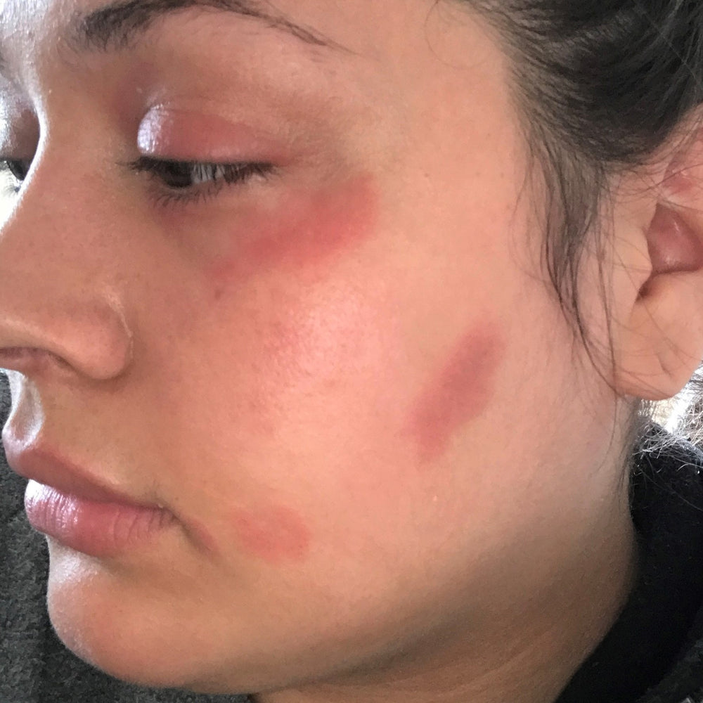 Red, irritated patches on the cheek before using Marin