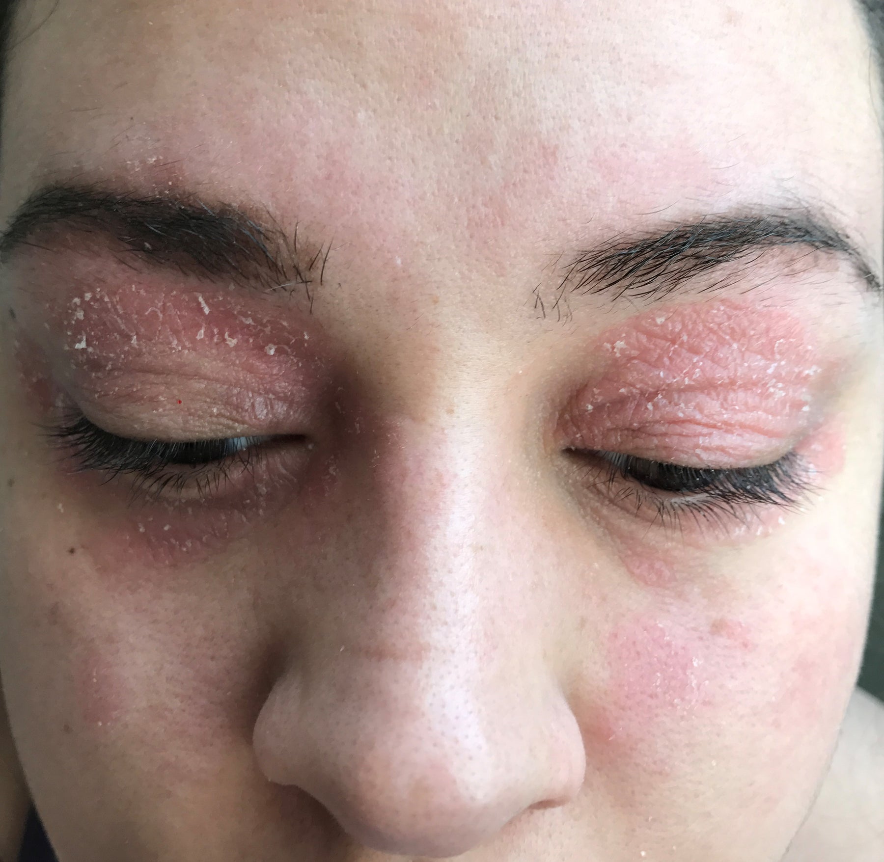 Close-up of dry, peeling skin around the eyes before Marin
